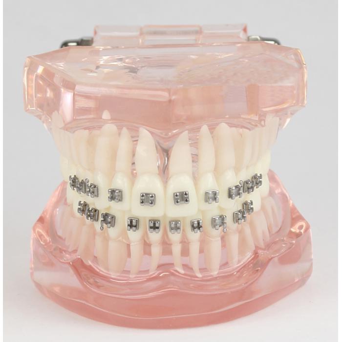 M3001 Dental Kieferorthopädie Behandlung Modell Demo Zähne MetallbracketsModel