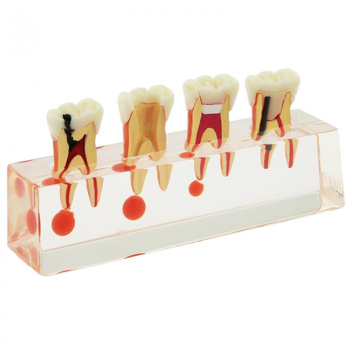 Zahnzähne Modell 4-stufige endodontische Behandlungsstudie Unterrichten Sie Modell 4018 01