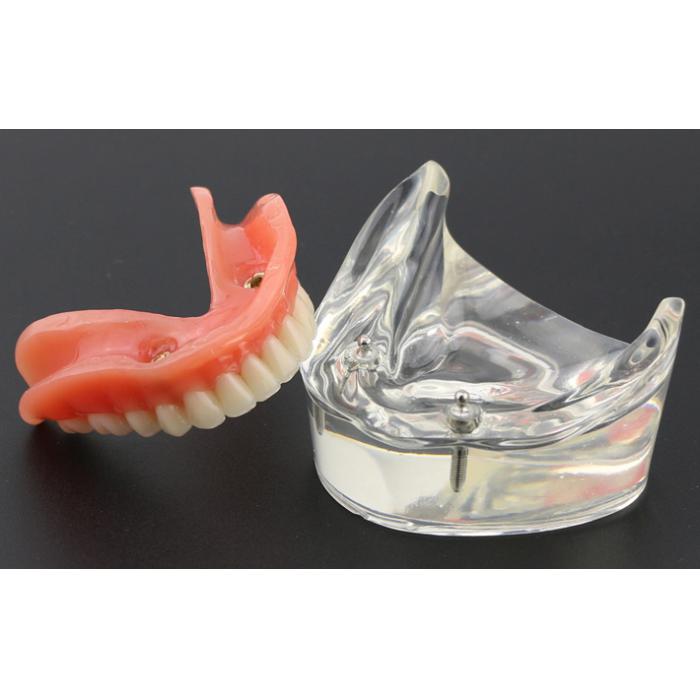 Modell für Zahnzähne Überprothese minderwertig bei 2 Implantaten Demo-Modell 6002 01