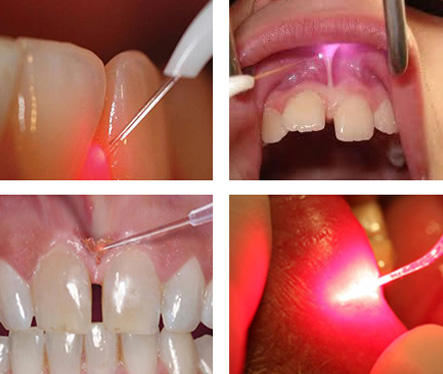 Dimed Berylas Blue Dental GaAlAs Diodenlaser 450nm/650nm/980nm 0.5W/4W/10W