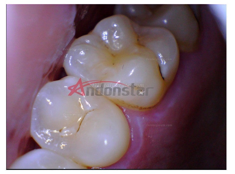 Dental Endoskop Lupe Oral HNO Kamera Vedio 2MP USB Digital Mikroskop