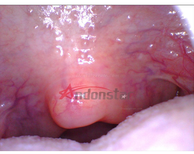 Dental Endoskop Lupe Oral HNO Kamera Vedio 2MP USB Digital Mikroskop