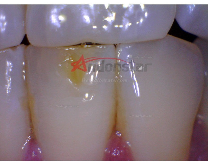 Dental Endoskop Lupe Oral HNO Kamera Vedio 2MP USB Digital Mikroskop