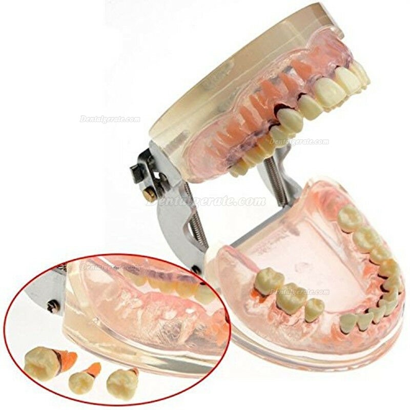 Dentalmodell Erwachsene Pathologische Parodontitis Studienzähne Modell 4017 Dentalmodell Erwachsene Pathologische Parodontitis Studienzähne Modell 4017
