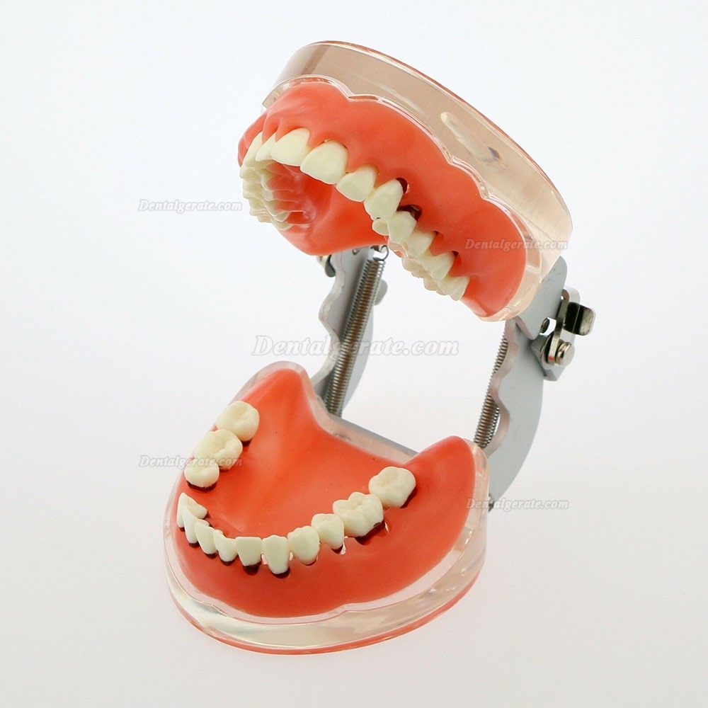Dentalmodell Erwachsene Pathologische Parodontitis Studienzähne Modell 4017 Dentalmodell Erwachsene Pathologische Parodontitis Studienzähne Modell 4017