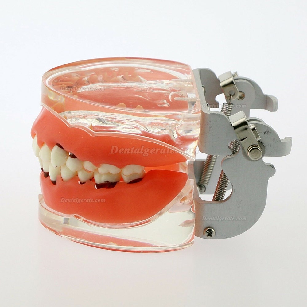 Dentalmodell Erwachsene Pathologische Parodontitis Studienzähne Modell 4017 Dentalmodell Erwachsene Pathologische Parodontitis Studienzähne Modell 4017