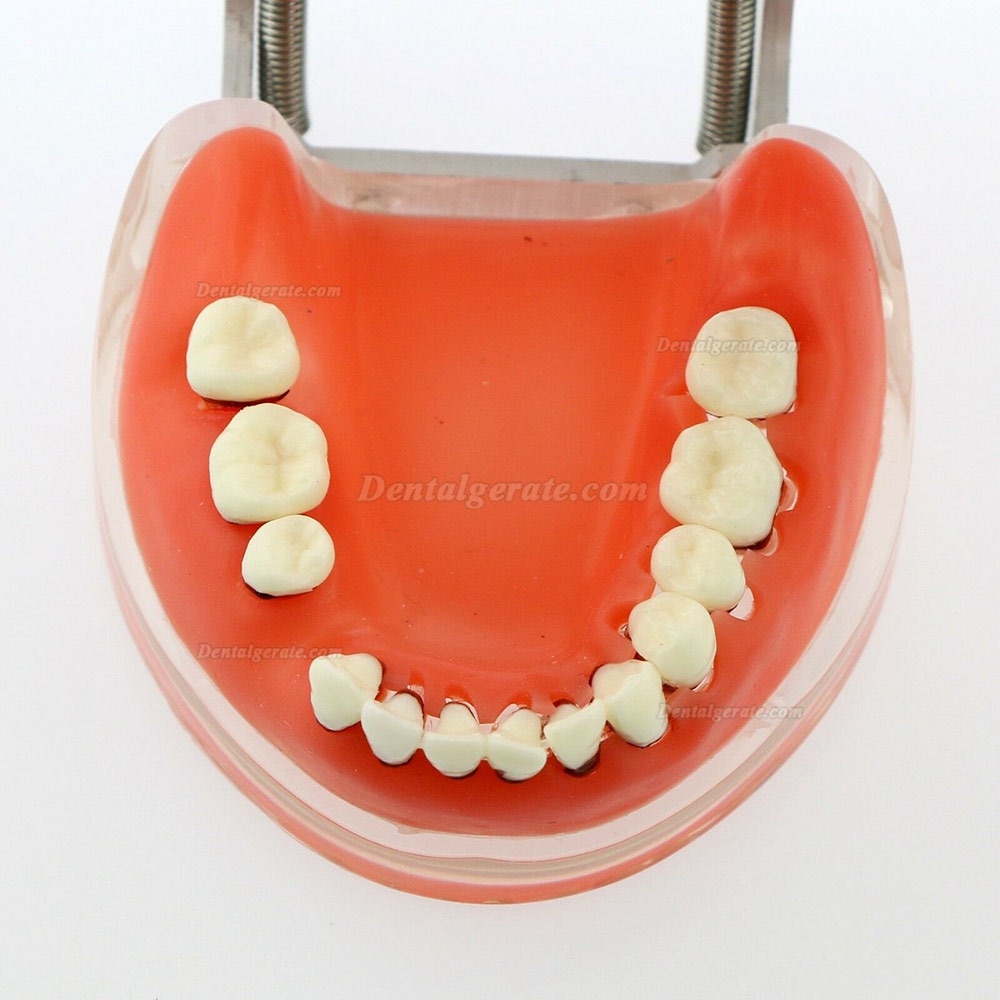 Dentalmodell Erwachsene Pathologische Parodontitis Studienzähne Modell 4017 Dentalmodell Erwachsene Pathologische Parodontitis Studienzähne Modell 4017