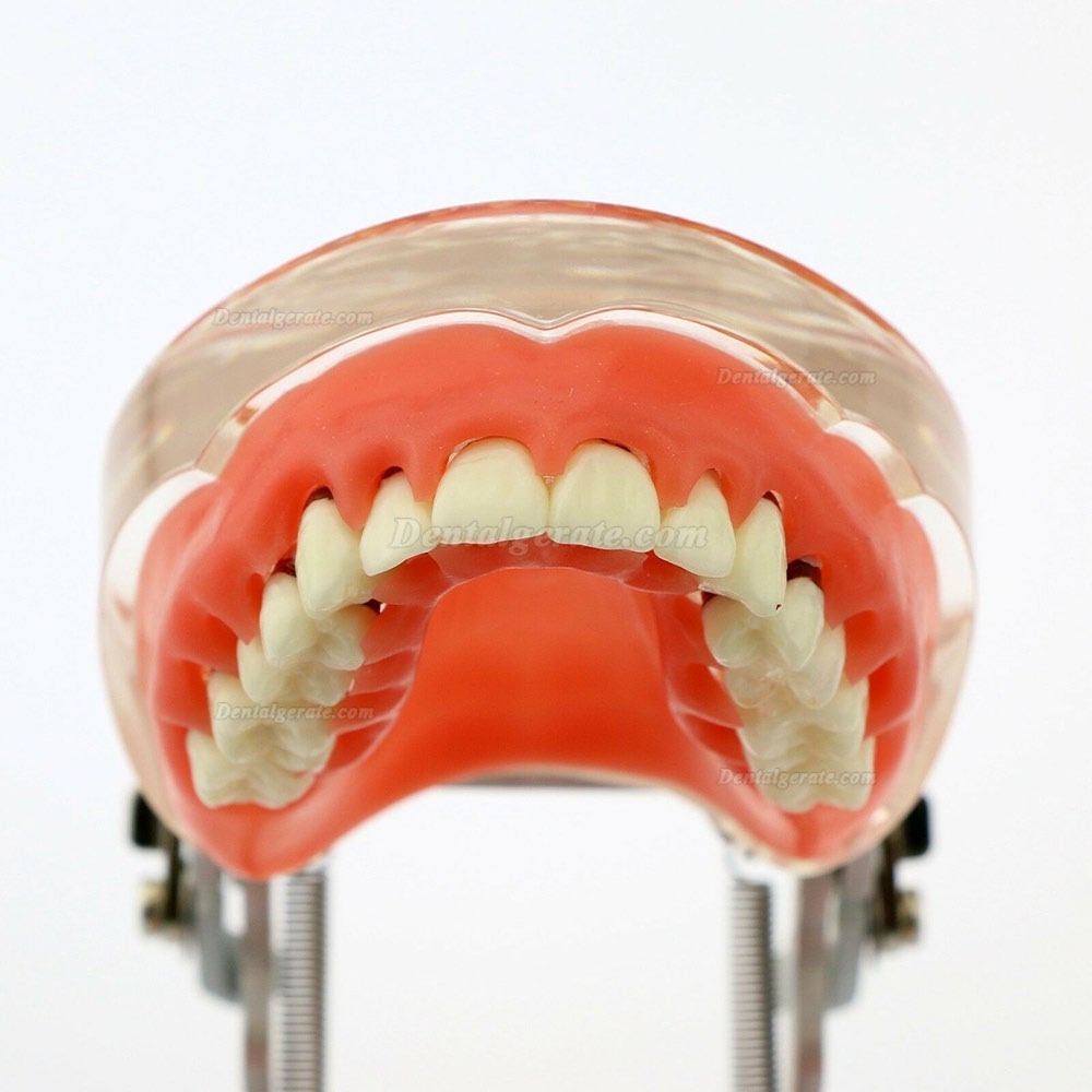 Dentalmodell Erwachsene Pathologische Parodontitis Studienzähne Modell 4017 Dentalmodell Erwachsene Pathologische Parodontitis Studienzähne Modell 4017