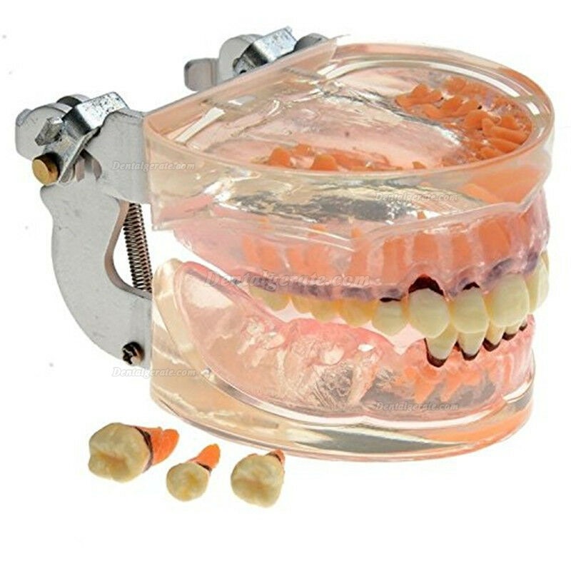 Dentalmodell Erwachsene Pathologische Parodontitis Studienzähne Modell 4017 Dentalmodell Erwachsene Pathologische Parodontitis Studienzähne Modell 4017