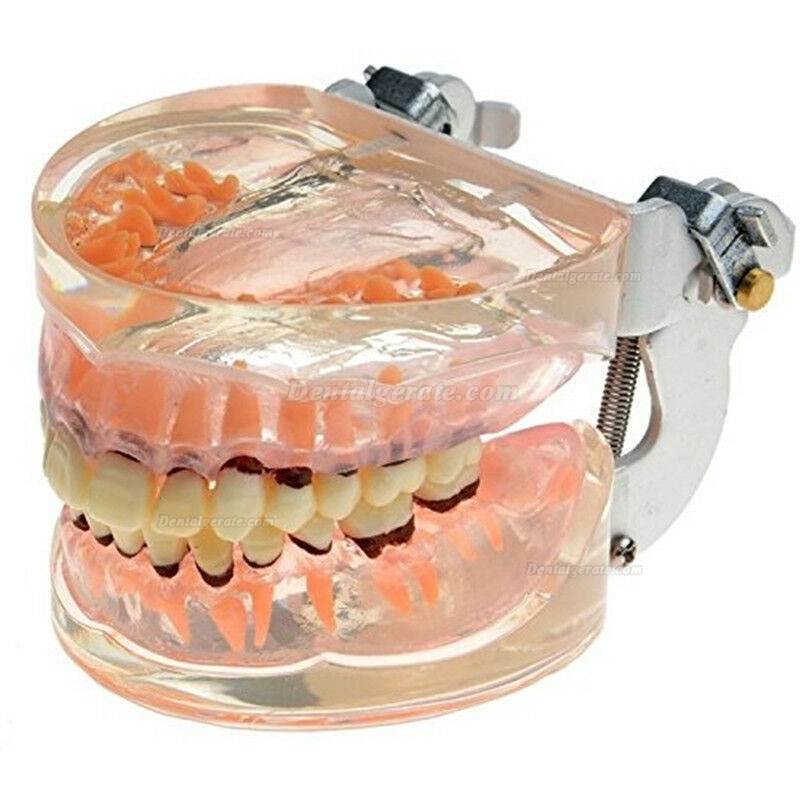 Dentalmodell Erwachsene Pathologische Parodontitis Studienzähne Modell 4017 Dentalmodell Erwachsene Pathologische Parodontitis Studienzähne Modell 4017