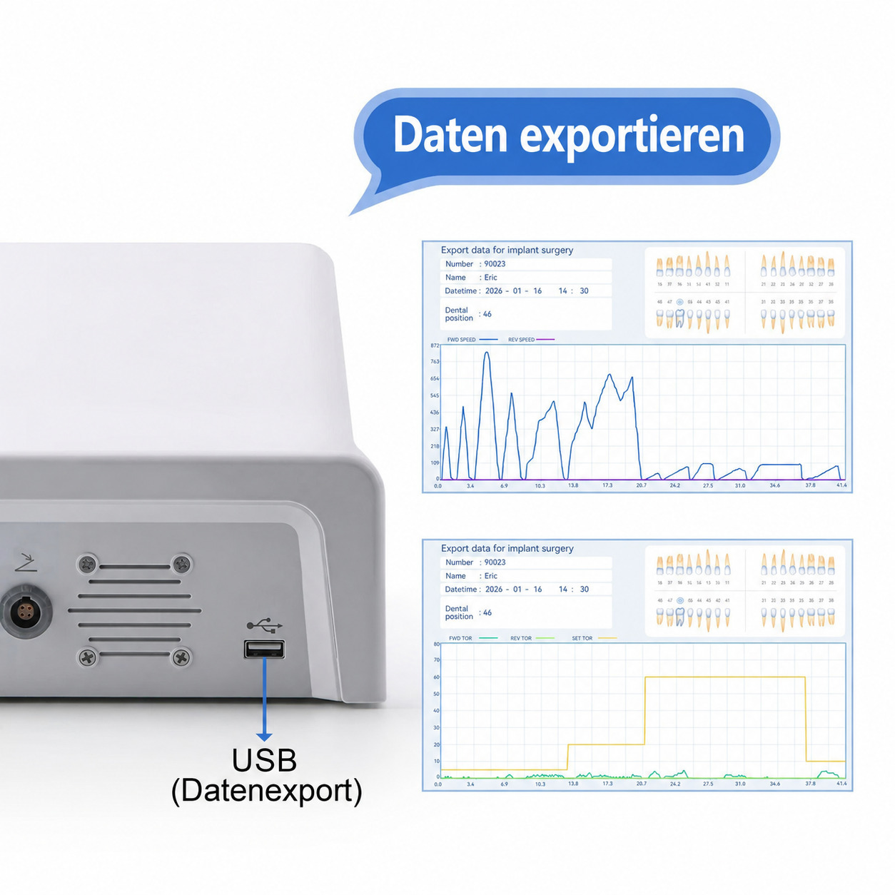 Betterway Surgic G3 Implantologiemotor f&uuml;r die Zahnmedizin + 20:1-Winkelst&uuml;ck