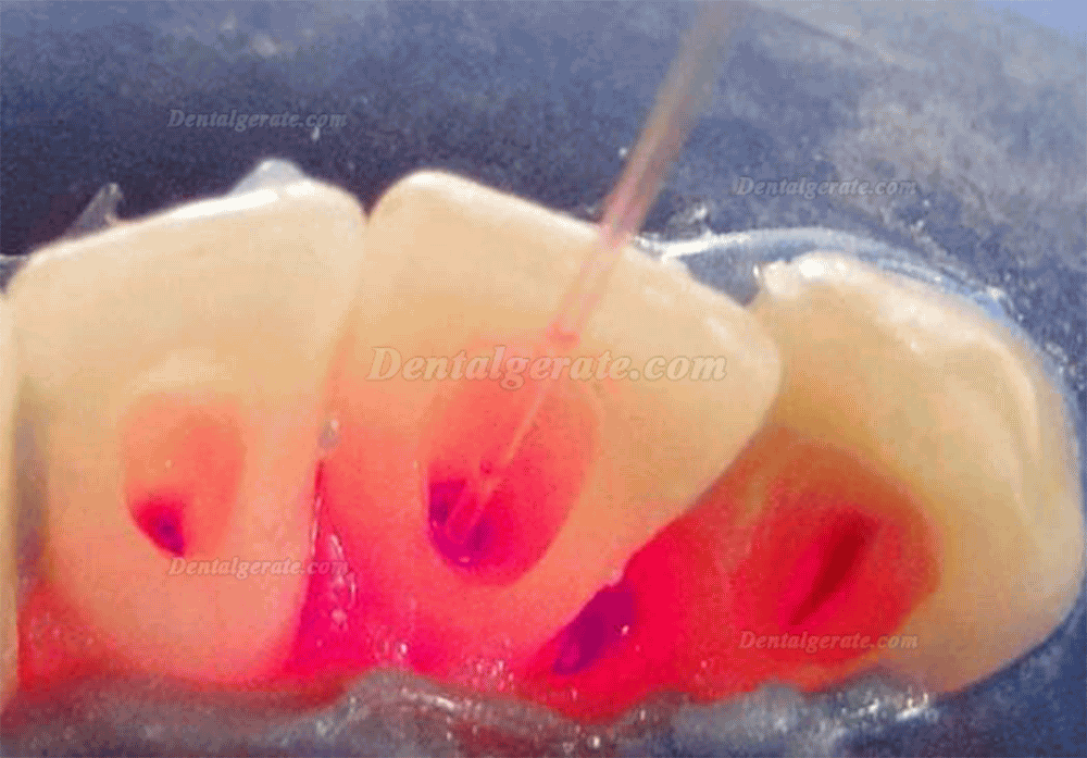 Dental diodenlaser stift f&uuml;r parodontale weichteile und endonotische chirurgie