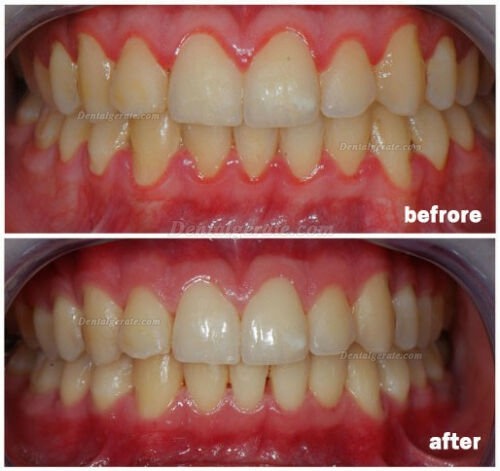 Dental diodenlaser stift f&uuml;r parodontale weichteile und endonotische chirurgie