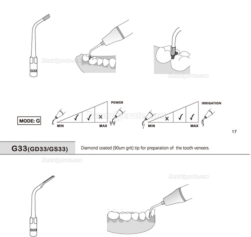 5 St&uuml;cke Refine&reg; Ultraschall Scaler Spitzen f&uuml;r Restauration G20 G21 G30 G31 G32 G33 G35 Kompatibel Mit Woodpecker EMS