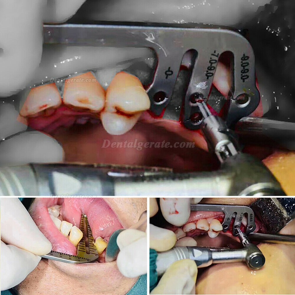 TT® Zahn Implantat FüHrung Set L&S Bohr Positionierungs Lineal Winkel Lineal Implantat Werkzeuge