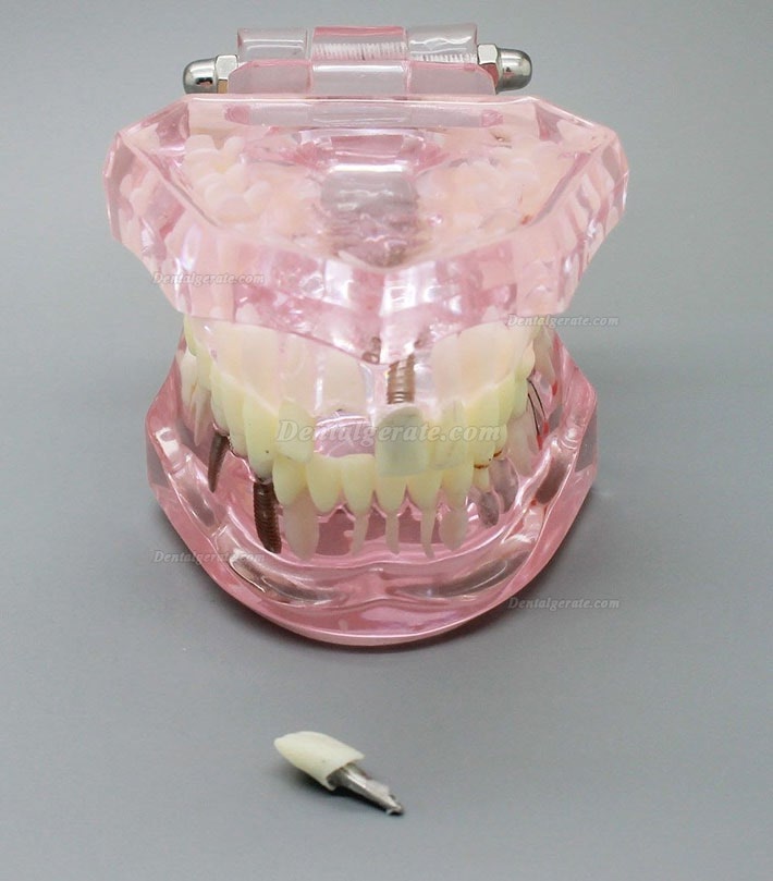 Zahnimplantatstudie Analyse Demonstration Zahnmodell mit Restauration 2001 Rosa Zahnimplantatstudie Analyse Demonstration Zahnmodell mit Restauration 2001 Rosa