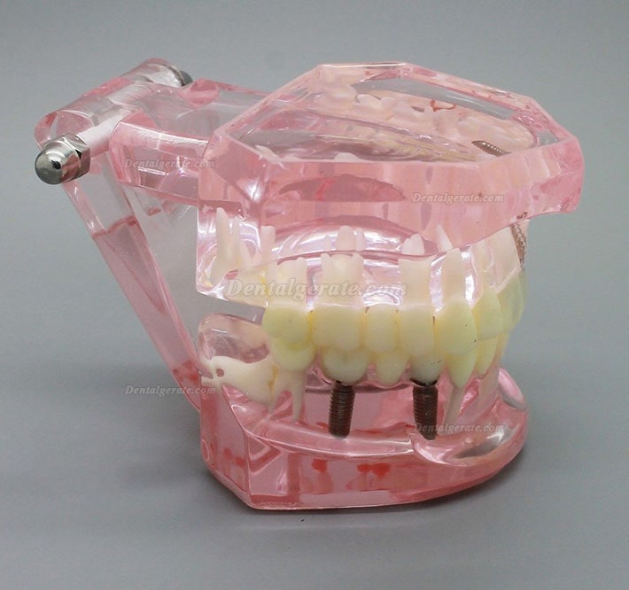 Zahnimplantatstudie Analyse Demonstration Zahnmodell mit Restauration 2001 Rosa Zahnimplantatstudie Analyse Demonstration Zahnmodell mit Restauration 2001 Rosa
