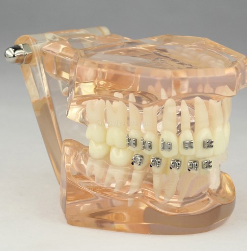 JX&reg; M3009 Kieferorthop&auml;disches Demonstrationsmodell der Zahnheilkunde mit den keramischen Halterungen