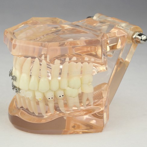 JX&reg; M3009 Kieferorthop&auml;disches Demonstrationsmodell der Zahnheilkunde mit den keramischen Halterungen
