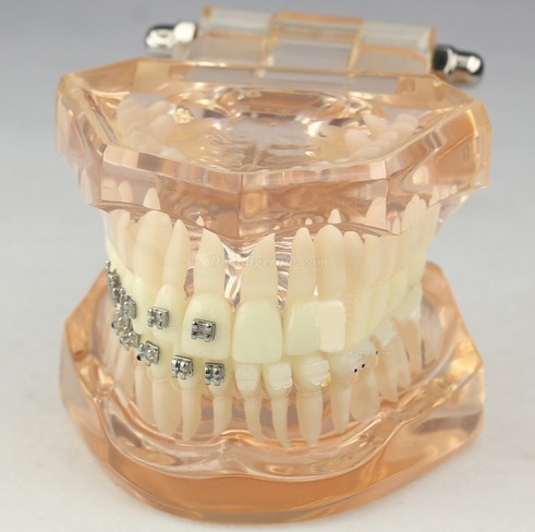 JX&reg; M3009 Kieferorthop&auml;disches Demonstrationsmodell der Zahnheilkunde mit den keramischen Halterungen