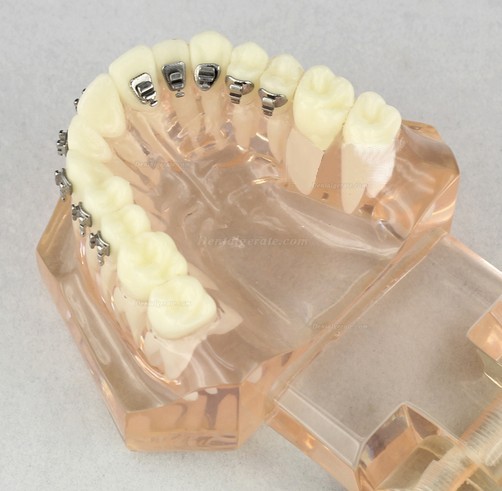 JX&reg; M3009 Kieferorthop&auml;disches Demonstrationsmodell der Zahnheilkunde mit den keramischen Halterungen
