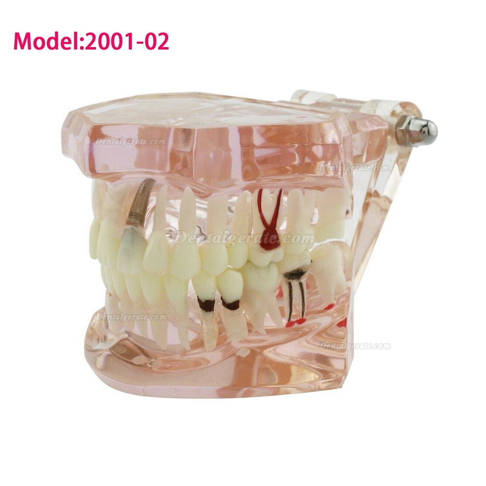 Modell der Zahnkrankheit Implant Demo Karies Parodont Transparent Rosa Modell der Zahnkrankheit Implant Demo Karies Parodont Transparent Rosa