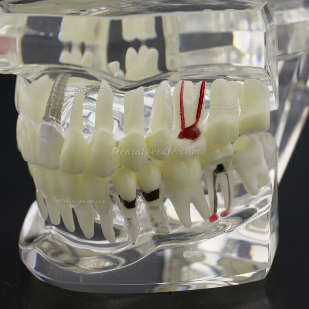 Modell der Zahnkrankheit Implant Demo Karies Parodont Transparent Rosa Modell der Zahnkrankheit Implant Demo Karies Parodont Transparent Rosa