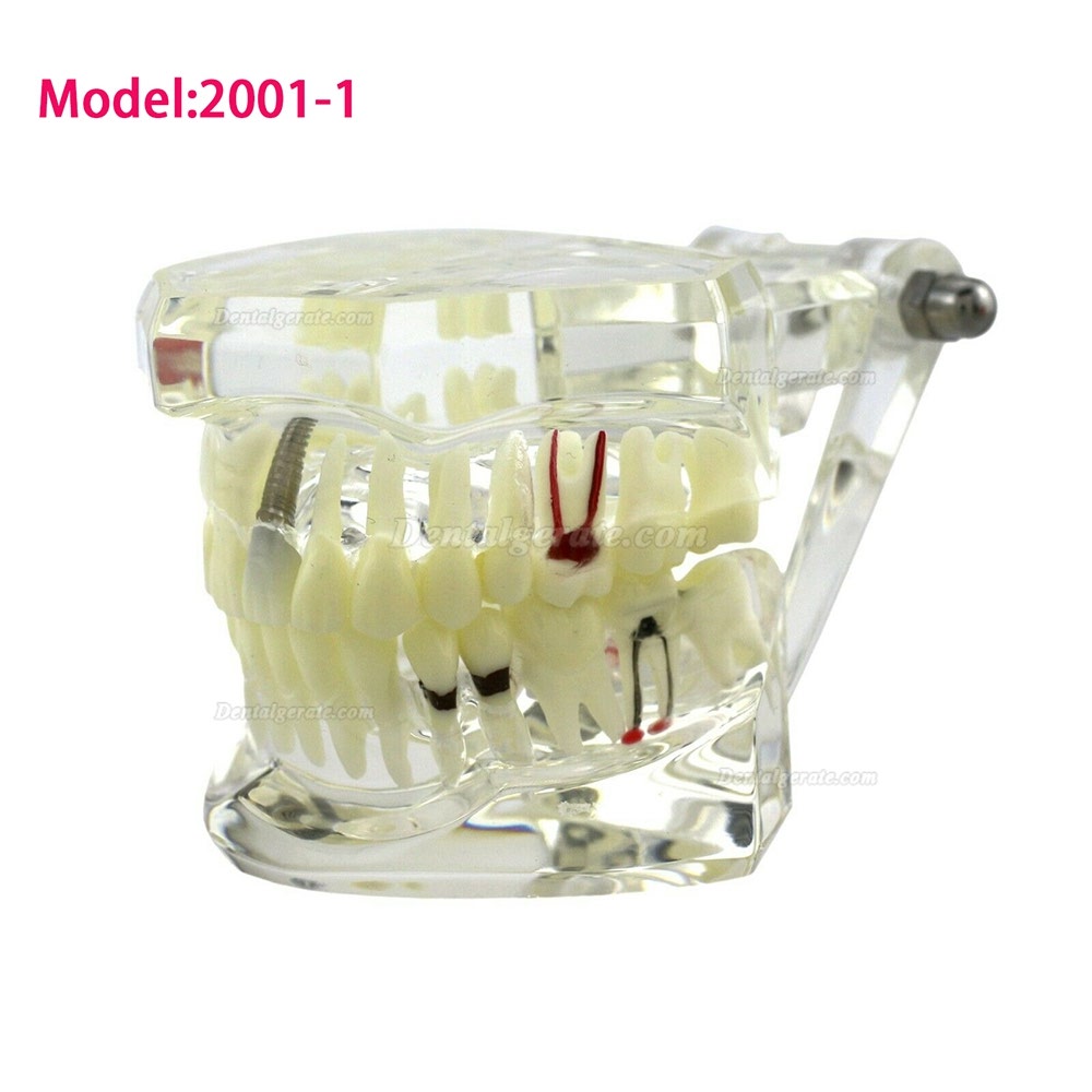 Modell der Zahnkrankheit Implant Demo Karies Parodont Transparent Rosa Modell der Zahnkrankheit Implant Demo Karies Parodont Transparent Rosa