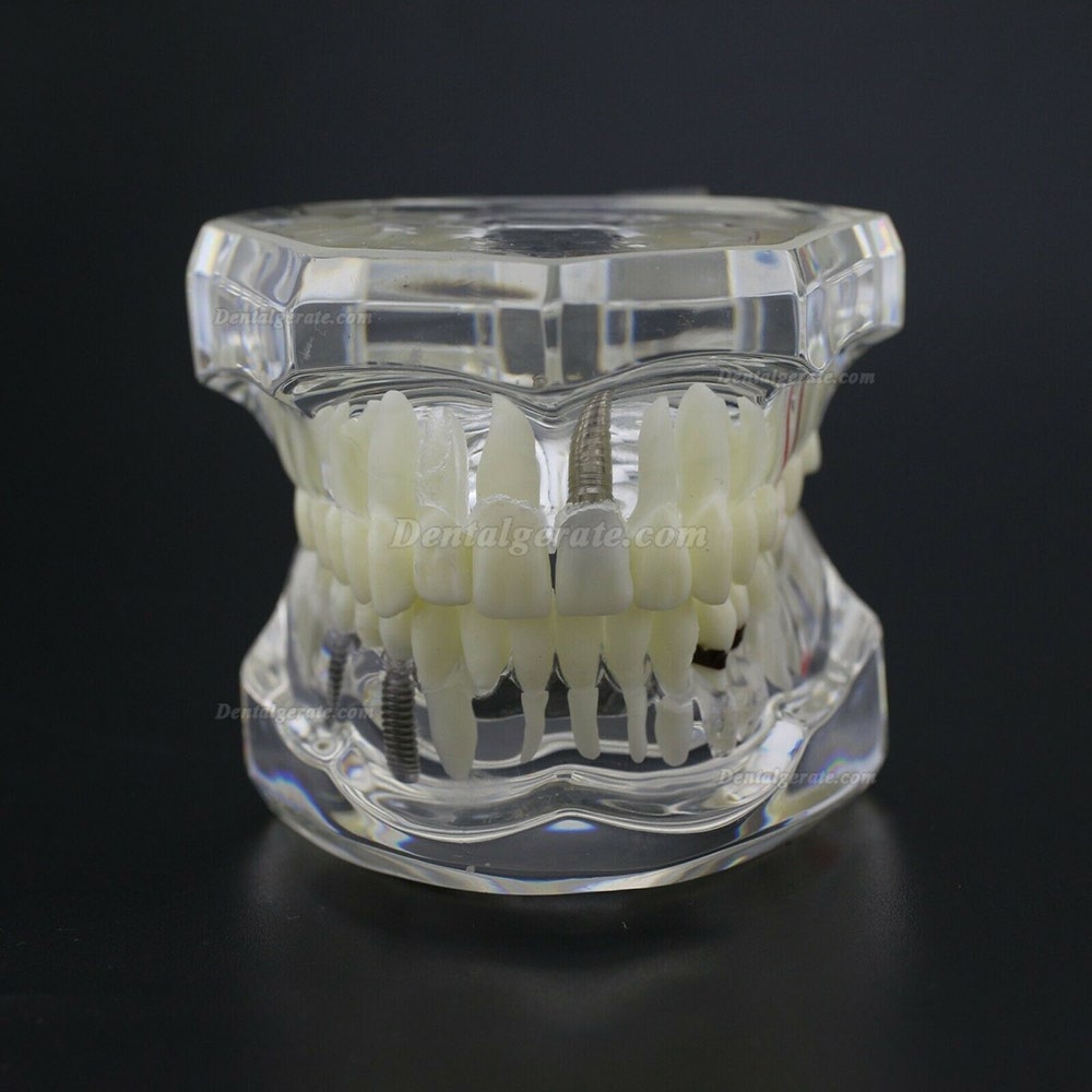 Modell der Zahnkrankheit Implant Demo Karies Parodont Transparent Rosa Modell der Zahnkrankheit Implant Demo Karies Parodont Transparent Rosa