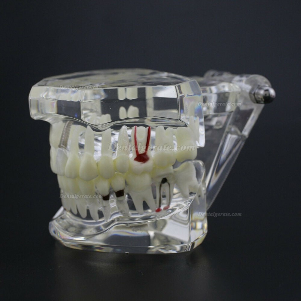 Modell der Zahnkrankheit Implant Demo Karies Parodont Transparent Rosa Modell der Zahnkrankheit Implant Demo Karies Parodont Transparent Rosa