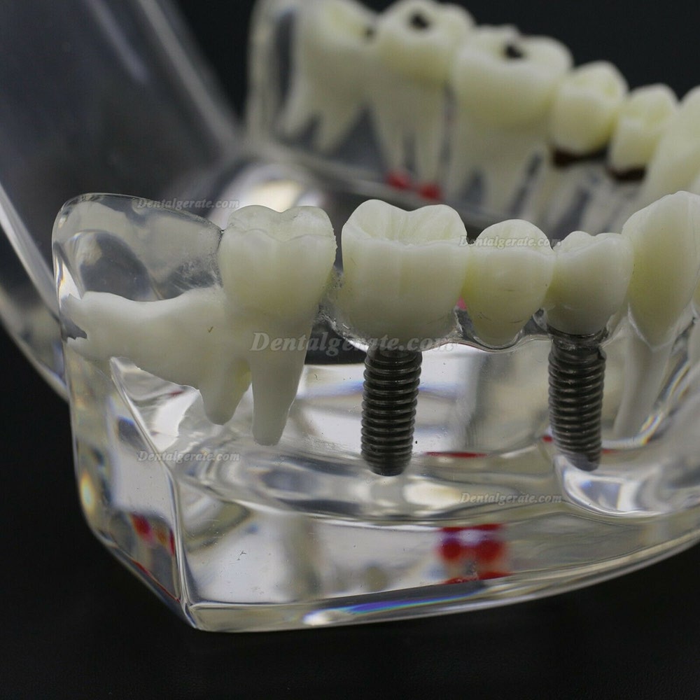 Modell der Zahnkrankheit Implant Demo Karies Parodont Transparent Rosa Modell der Zahnkrankheit Implant Demo Karies Parodont Transparent Rosa
