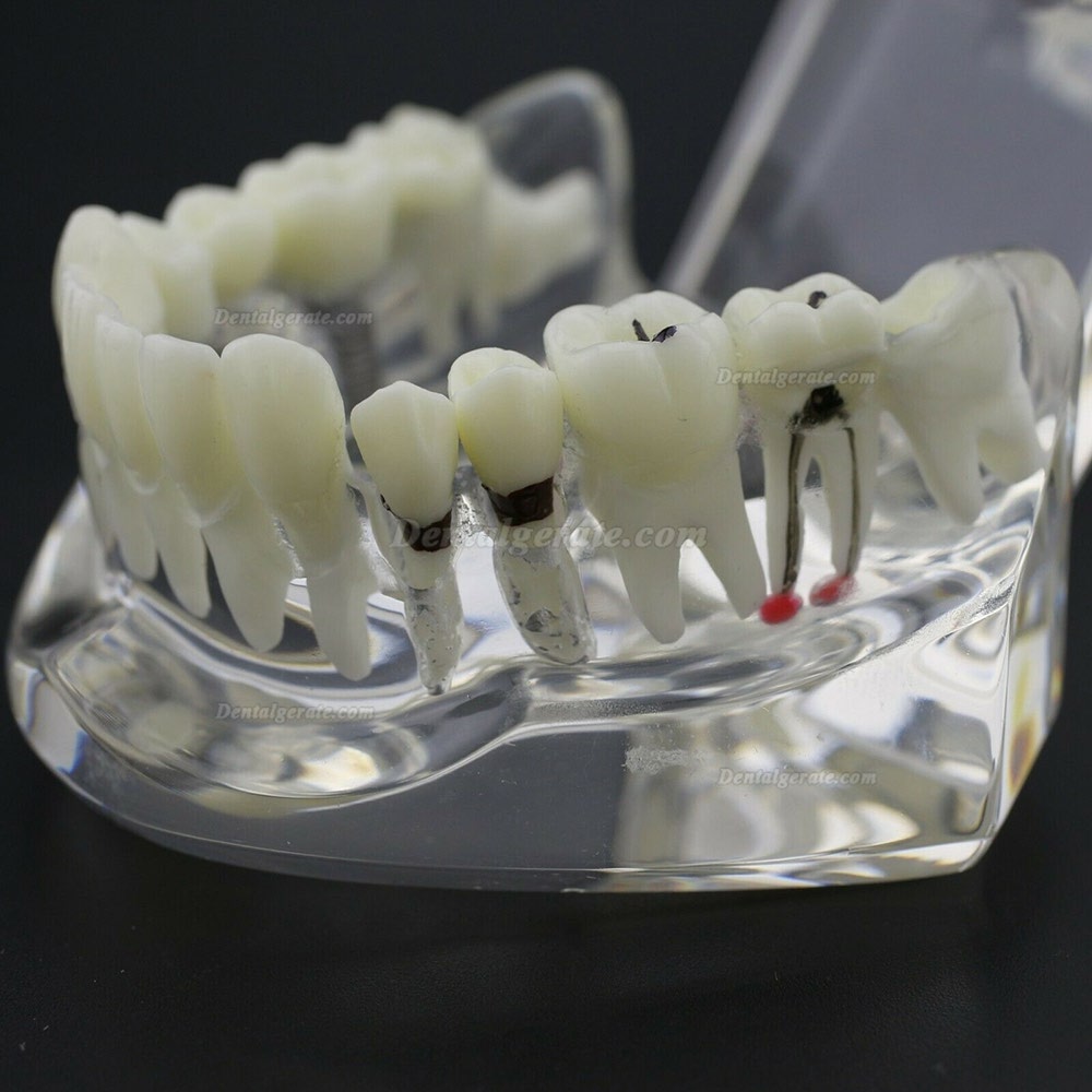 Modell der Zahnkrankheit Implant Demo Karies Parodont Transparent Rosa Modell der Zahnkrankheit Implant Demo Karies Parodont Transparent Rosa