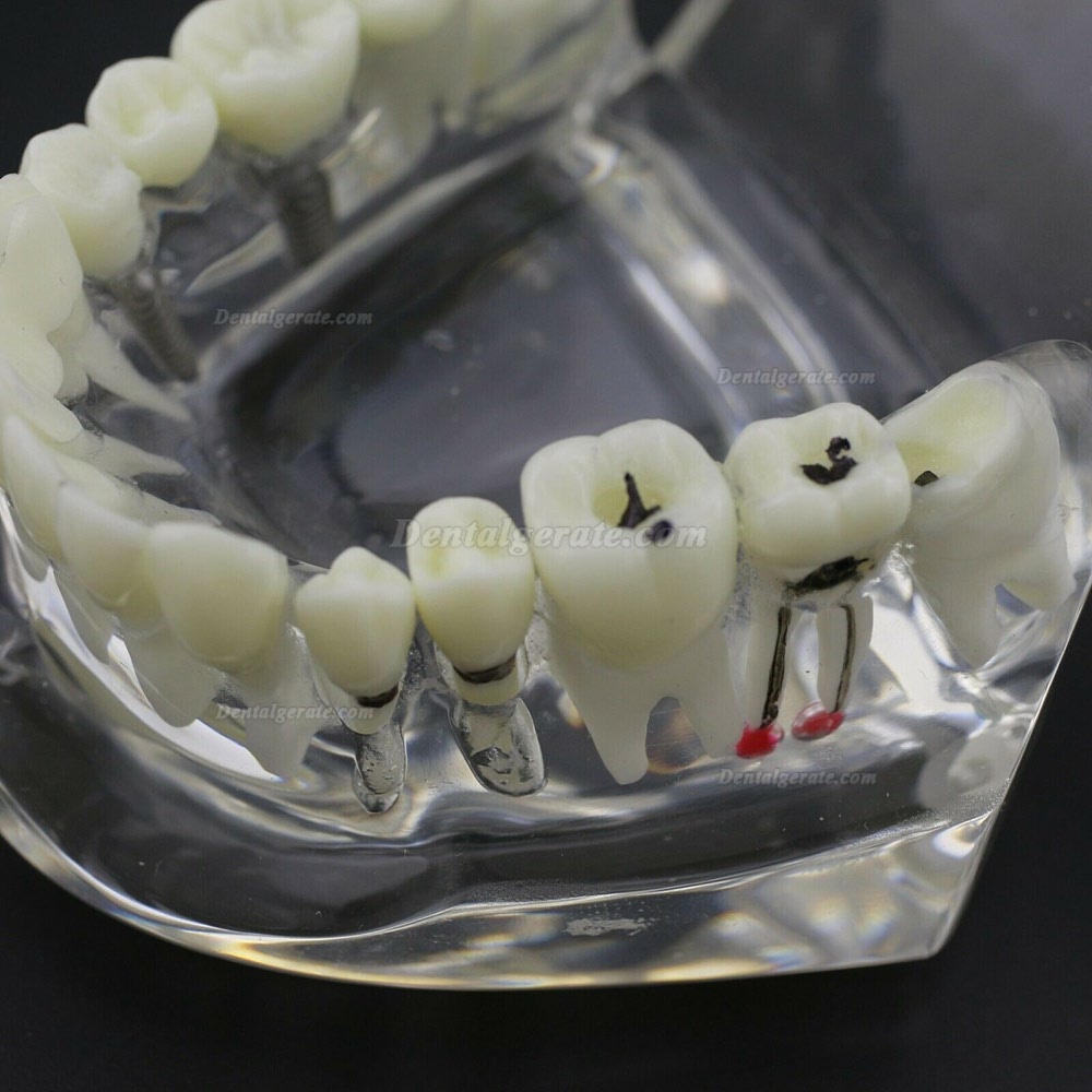 Modell der Zahnkrankheit Implant Demo Karies Parodont Transparent Rosa Modell der Zahnkrankheit Implant Demo Karies Parodont Transparent Rosa