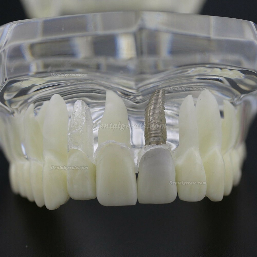 Modell der Zahnkrankheit Implant Demo Karies Parodont Transparent Rosa Modell der Zahnkrankheit Implant Demo Karies Parodont Transparent Rosa