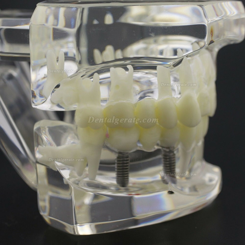 Modell der Zahnkrankheit Implant Demo Karies Parodont Transparent Rosa Modell der Zahnkrankheit Implant Demo Karies Parodont Transparent Rosa