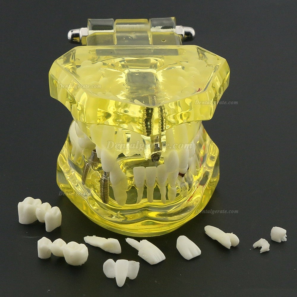 Modell der Zahnzähne Unterrichten Sie das Studium Oral Implantatversorgung & Pathologie 2001 Gelb Modell der Zahnzähne Unterrichten Sie das Studium Oral Implantatversorgung & Pathologie 2001 Gelb