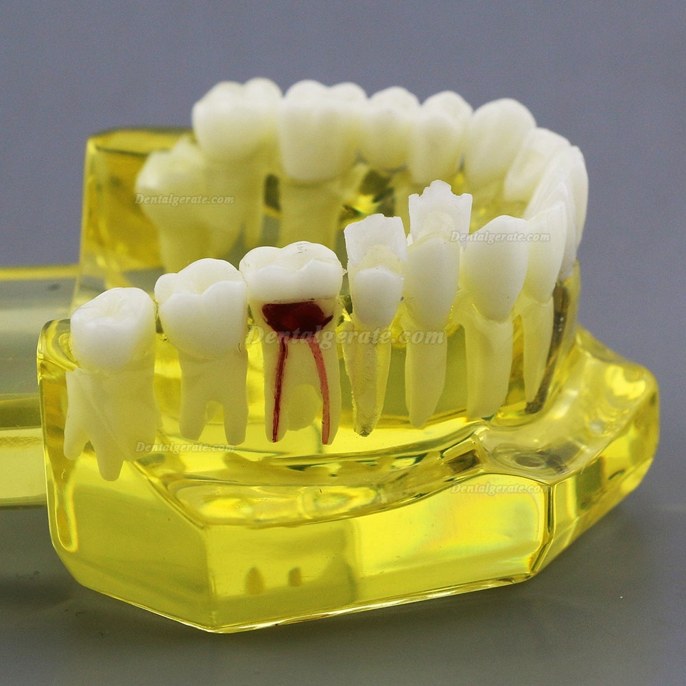 Modell der Zahnzähne Unterrichten Sie das Studium Oral Implantatversorgung & Pathologie 2001 Gelb Modell der Zahnzähne Unterrichten Sie das Studium Oral Implantatversorgung & Pathologie 2001 Gelb