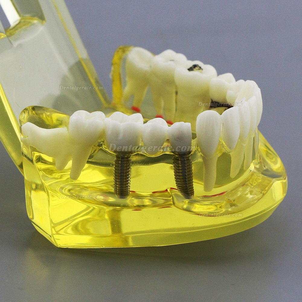 Modell der Zahnzähne Unterrichten Sie das Studium Oral Implantatversorgung & Pathologie 2001 Gelb Modell der Zahnzähne Unterrichten Sie das Studium Oral Implantatversorgung & Pathologie 2001 Gelb