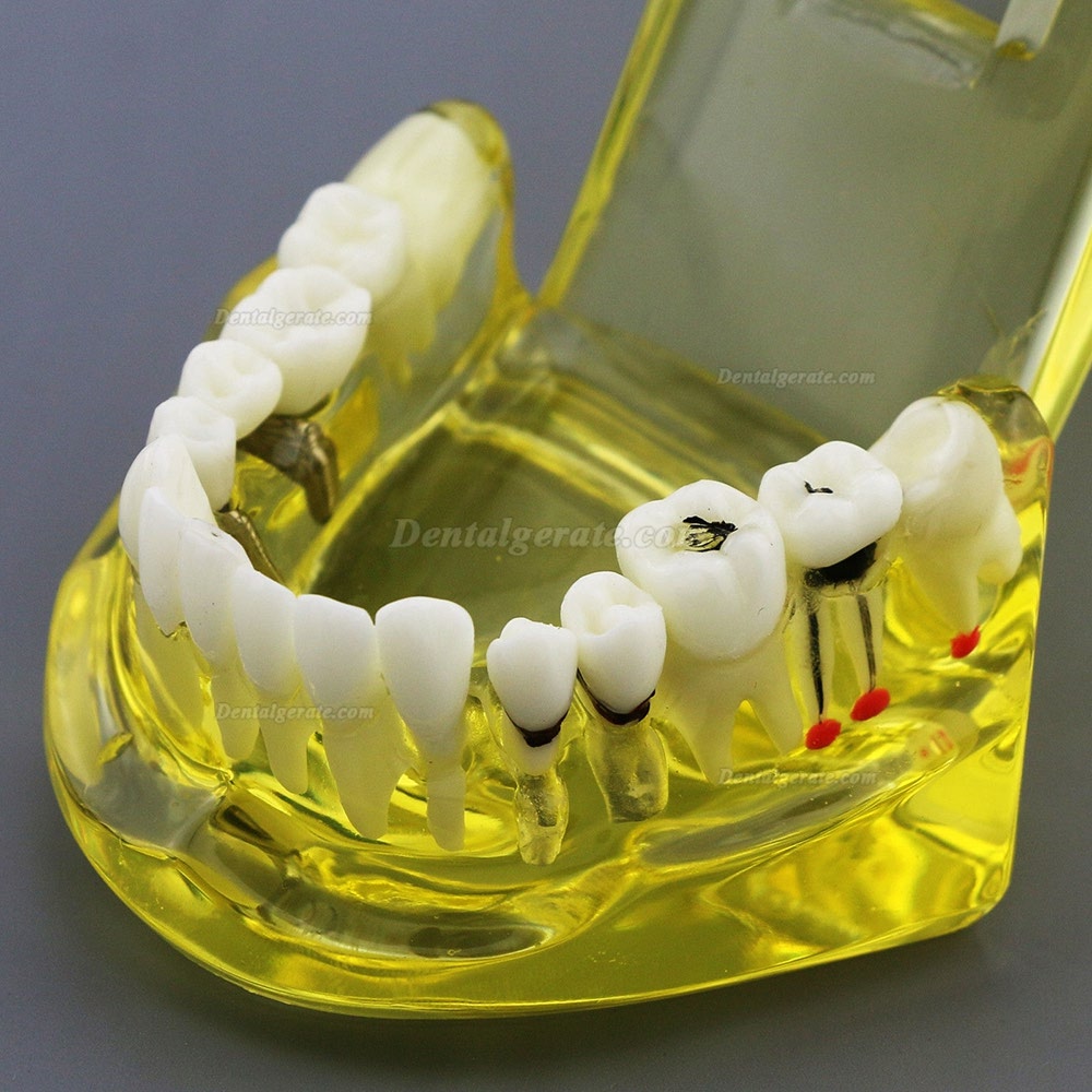 Modell der Zahnzähne Unterrichten Sie das Studium Oral Implantatversorgung & Pathologie 2001 Gelb Modell der Zahnzähne Unterrichten Sie das Studium Oral Implantatversorgung & Pathologie 2001 Gelb