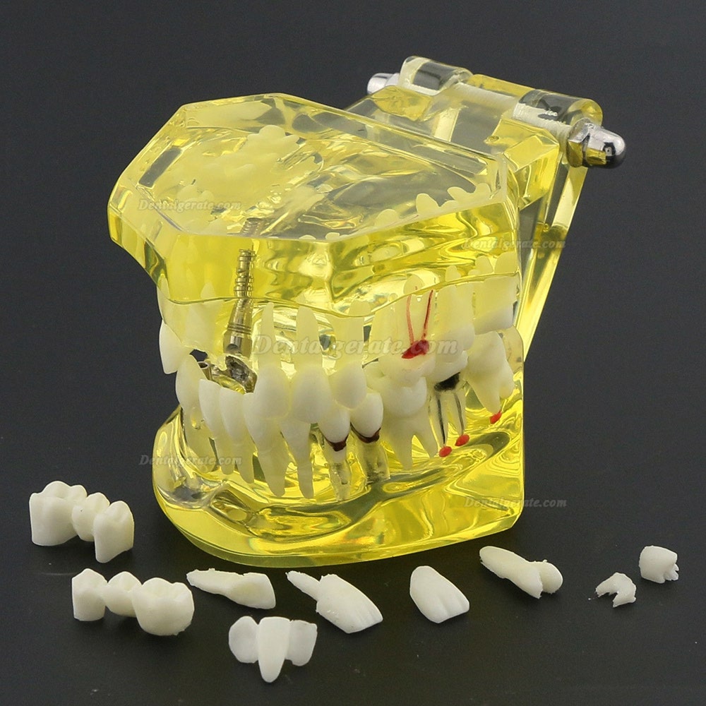 Modell der Zahnzähne Unterrichten Sie das Studium Oral Implantatversorgung & Pathologie 2001 Gelb Modell der Zahnzähne Unterrichten Sie das Studium Oral Implantatversorgung & Pathologie 2001 Gelb