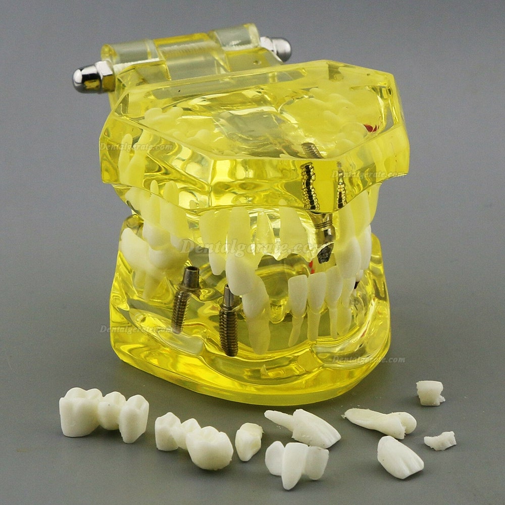 Modell der Zahnzähne Unterrichten Sie das Studium Oral Implantatversorgung & Pathologie 2001 Gelb Modell der Zahnzähne Unterrichten Sie das Studium Oral Implantatversorgung & Pathologie 2001 Gelb