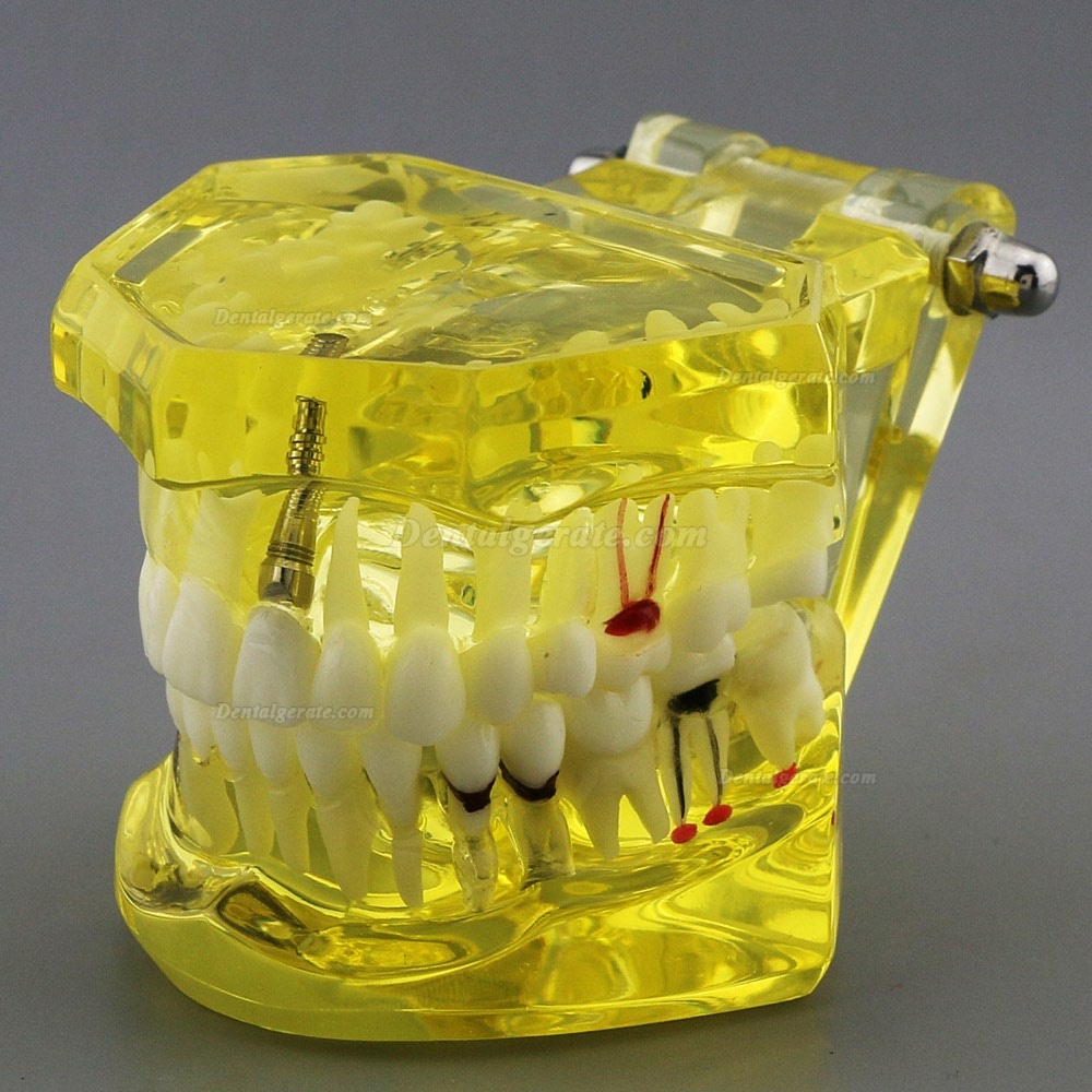 Modell der Zahnzähne Unterrichten Sie das Studium Oral Implantatversorgung & Pathologie 2001 Gelb Modell der Zahnzähne Unterrichten Sie das Studium Oral Implantatversorgung & Pathologie 2001 Gelb