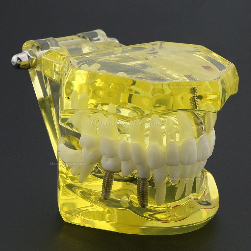 Modell der Zahnzähne Unterrichten Sie das Studium Oral Implantatversorgung & Pathologie 2001 Gelb Modell der Zahnzähne Unterrichten Sie das Studium Oral Implantatversorgung & Pathologie 2001 Gelb