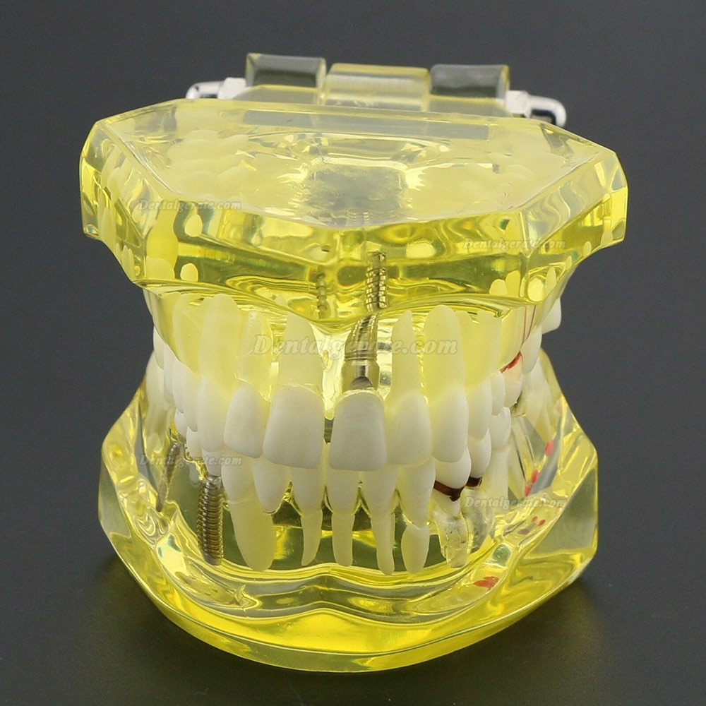 Modell der Zahnzähne Unterrichten Sie das Studium Oral Implantatversorgung & Pathologie 2001 Gelb Modell der Zahnzähne Unterrichten Sie das Studium Oral Implantatversorgung & Pathologie 2001 Gelb