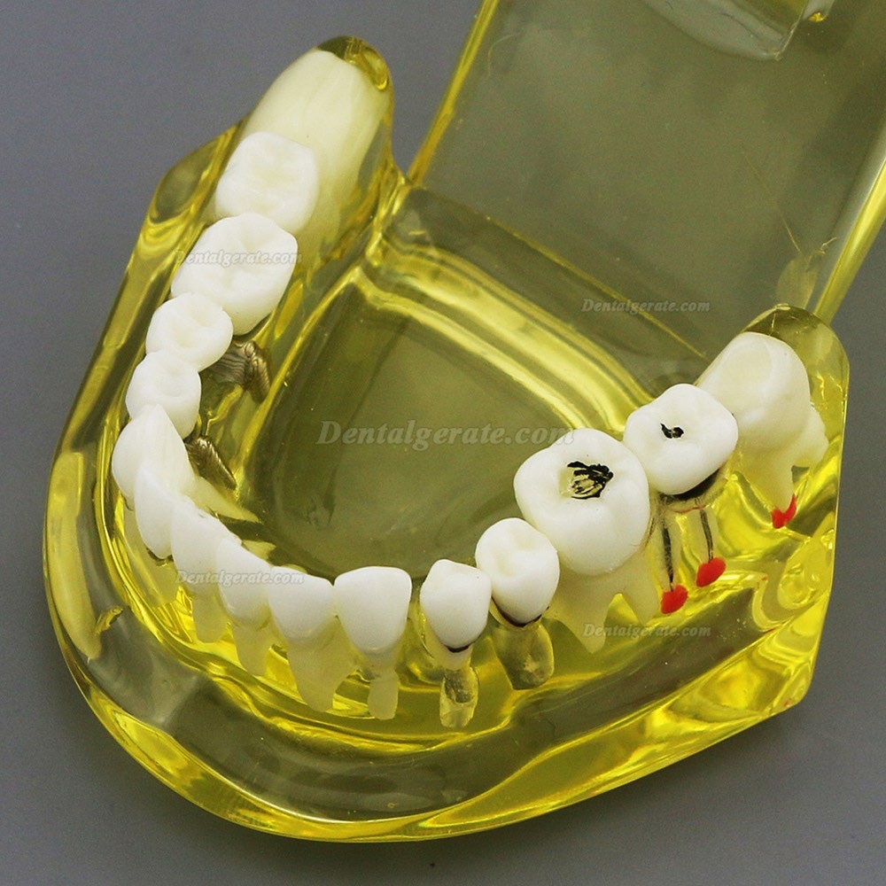 Modell der Zahnzähne Unterrichten Sie das Studium Oral Implantatversorgung & Pathologie 2001 Gelb Modell der Zahnzähne Unterrichten Sie das Studium Oral Implantatversorgung & Pathologie 2001 Gelb