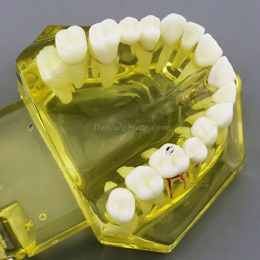 Modell der Zahnzähne Unterrichten Sie das Studium Oral Implantatversorgung & Pathologie 2001 Gelb Modell der Zahnzähne Unterrichten Sie das Studium Oral Implantatversorgung & Pathologie 2001 Gelb