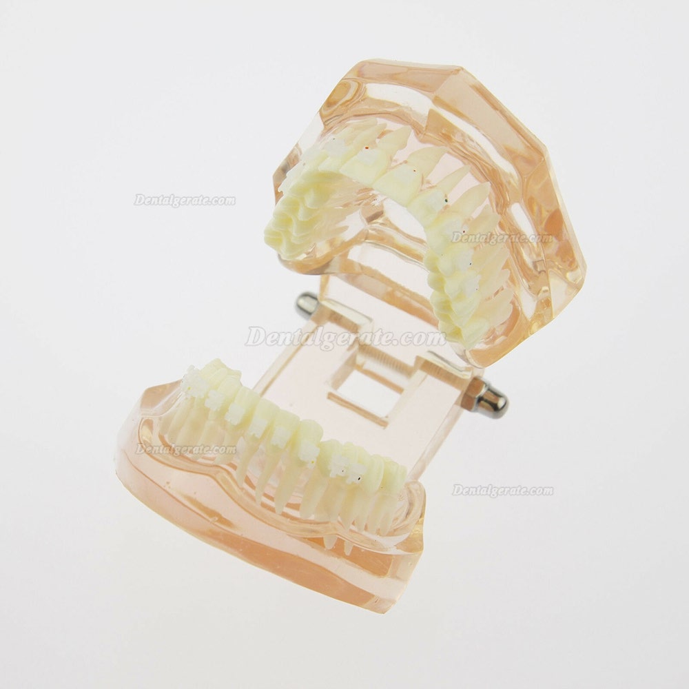 Dental Kieferorthop&auml;die Behandlung Modell Demo Z&auml;hne Keramikbrackets # 3002