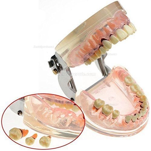 Dental Studie transparent Erwachsene pathologischen Parodontale Erkrankungen Z&auml;hne Modell 4017