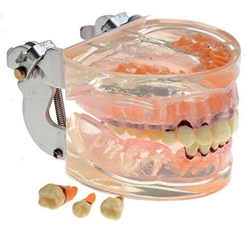 Dental Studie transparent Erwachsene pathologischen Parodontale Erkrankungen Z&auml;hne Modell 4017