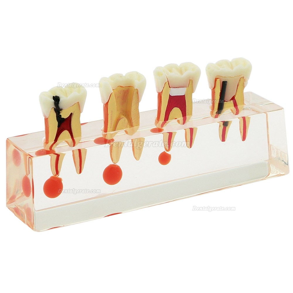 Zahnzähne Modell 4-stufige endodontische Behandlungsstudie Unterrichten Sie Modell 4018 01